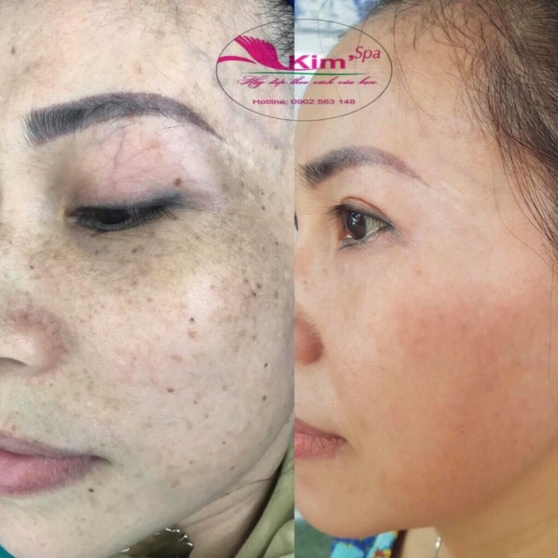 Kem Tái Tạo Da Đông Y Tái Tạo Da Mặt Hiệu Quả Loại Bỏ Mụn Nám Tàn Nhang