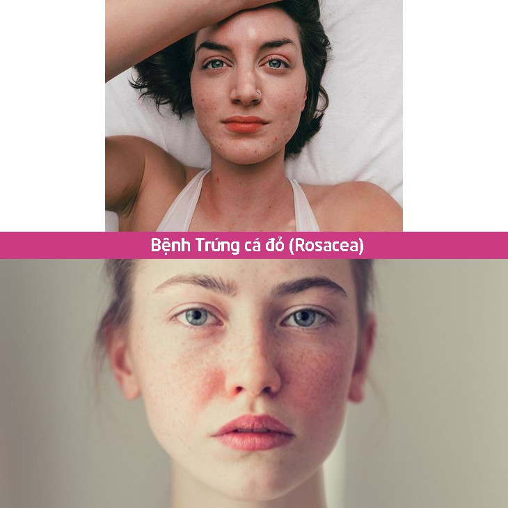 CANOVA Sensiven P22 50mL - Kem Làm Dịu Da, Dưỡng Ẩm Dành Cho Da Nhạy Cảm.