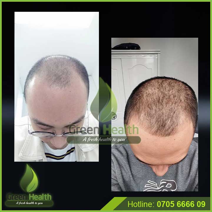 Serum mọc tóc - Minoxidil &amp; Finasteride 10% - Morr F 10% F10 (60ml)