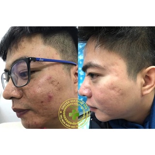 Bạch hồng đơn phổ thông(100%hàng công ty date mơi nhất)