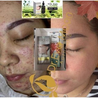 kem sẹo collagen handmade