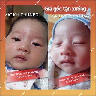 KEM BÔI CHÀM SỮA CỰC TỐT