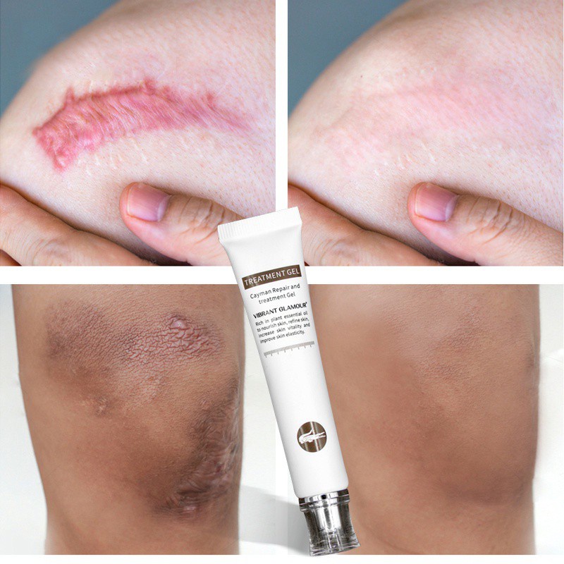 Gel Cá Sấu Hỗ trợ giảm sẹo Mụn Làm Sáng Da 20g
