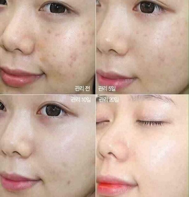 Tinh chất giảm mụn Skin1004 centella madagaska centella chiết xuất từ rau má
