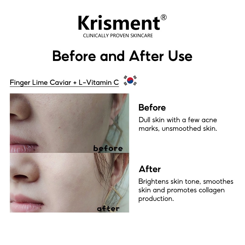 Krisment Serum Azelaic Acid + L-Vitamin C làm mờ vết thâm và vết thâm mụn  30ml