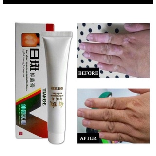 thảo dược bôi bạch biến