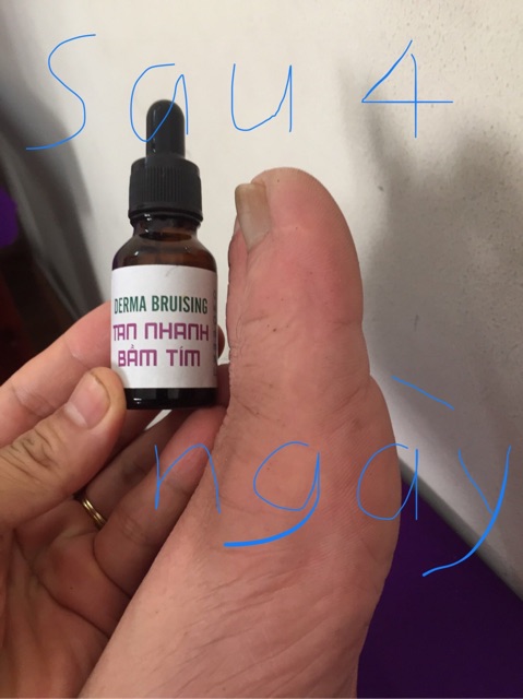 Gel bôi tan nhanh bầm tím - giảm sưng nề do chấn thương-sau thẩm mỹ DERMA BRUISING