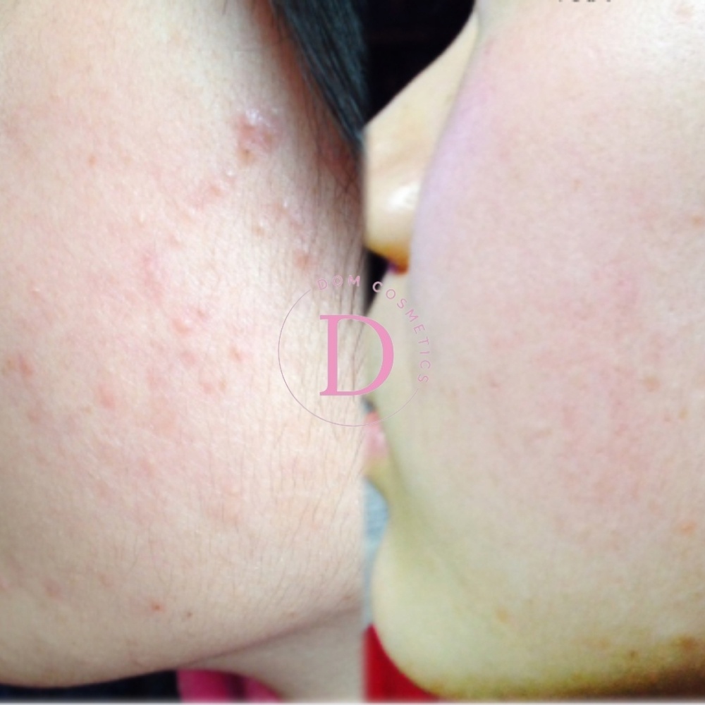 (Mẫu mới 90ml ) LOTION GIẢM MỤN BIGANSUI MEISHOKU | BigBuy360 - bigbuy360.vn