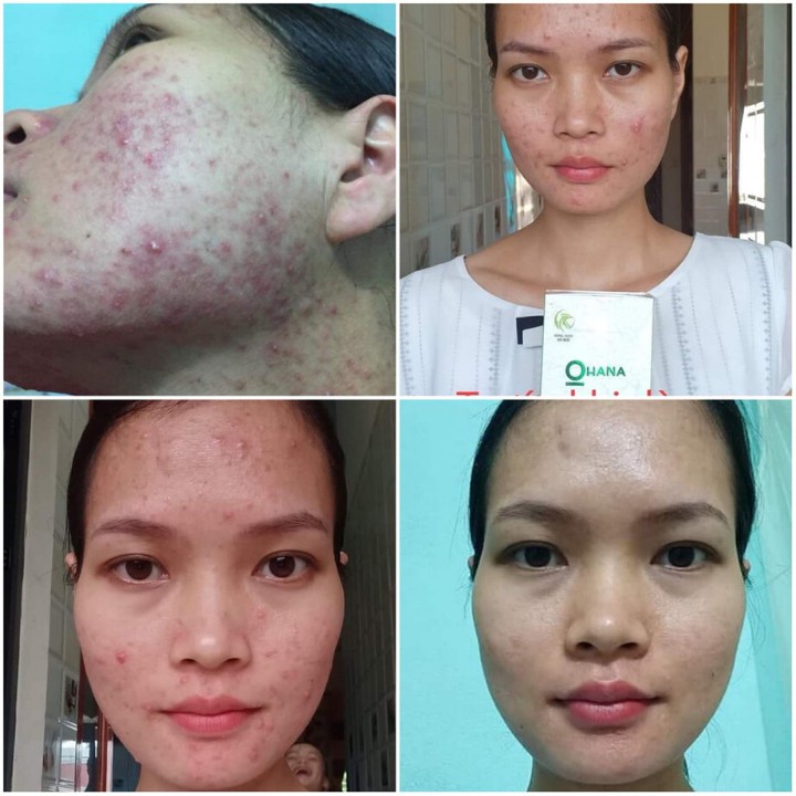 Serum Trị Mụn Cao Cấp 💖FREESHIP💖 Huyết Hồng Sâm Trị Mụn | Trị thâm | Mờ sẹo Rỗ Se Khít Lỗ Chân Lông | BigBuy360 - bigbuy360.vn