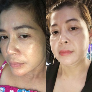 KEM MỤN MỜ SẸO MỜ THÂM