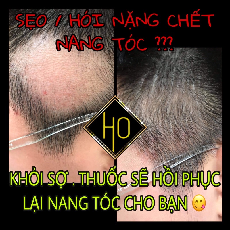 [CAO CẤP]MỌC TÓC THƯA HÓI SẸO HO X3PLUS 20% 60ML