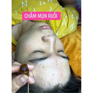 Chấm nám chân sâu, sẹo rỗ đức thịnh handmade( có video hưỡng dẫn chấm ) handmade