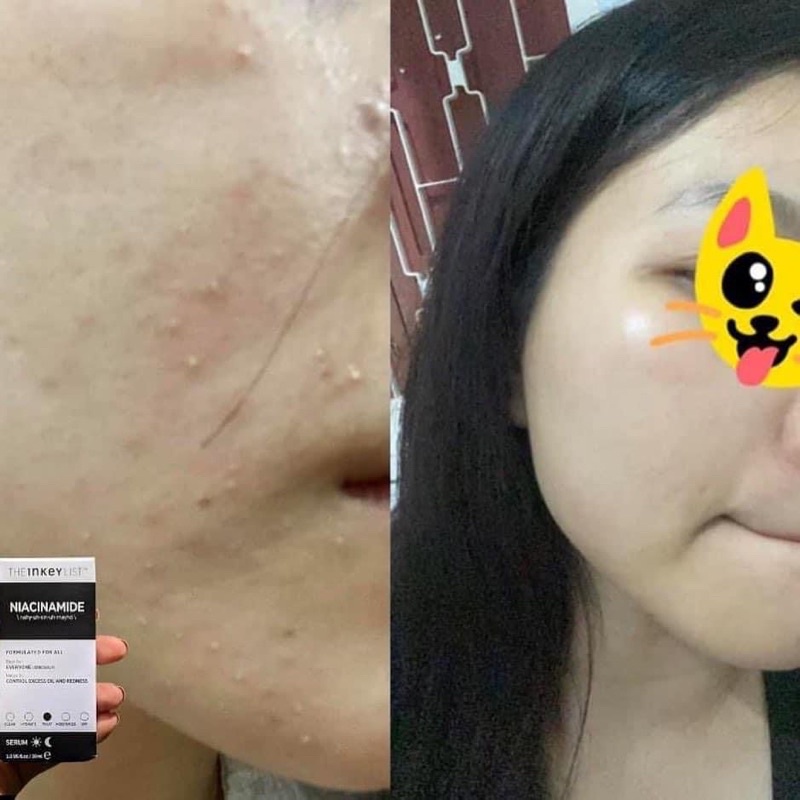 Tinh chất dưỡng da Niacinamide The Inkey List se khít lỗ chân lông, mờ thâm mụn