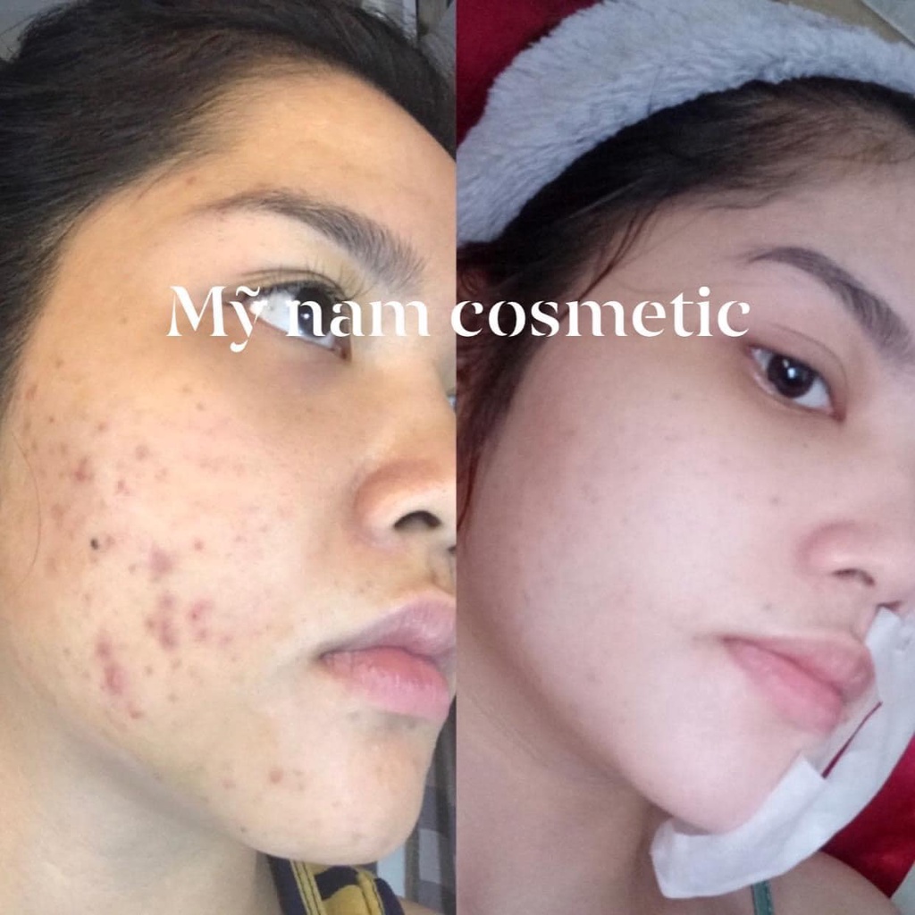 Combo dưỡng da mỹ nam -cải thiên tận gốc mụn, thâm nám, tàn nhang
