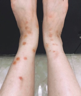 Cao sẹo collagen