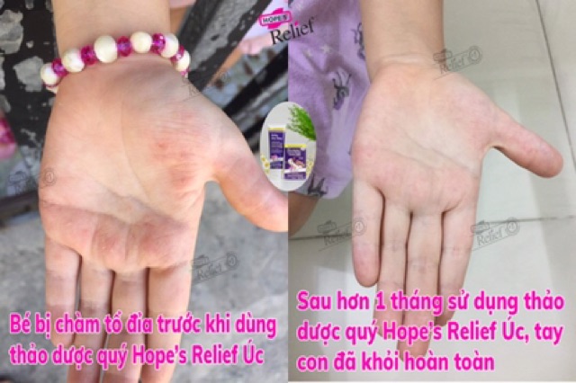 [DEAL SỐC] Kem đa năng dưỡng ẩm, hỗ trợ phục hồi da khô, ngứa Hope’s Relief 60g | BigBuy360 - bigbuy360.vn