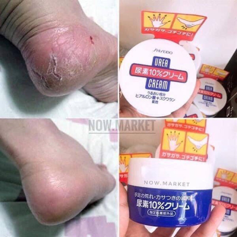 Kem trị nứt gót chân, ngón tay Shiseido Urea Cream Nhật Bản