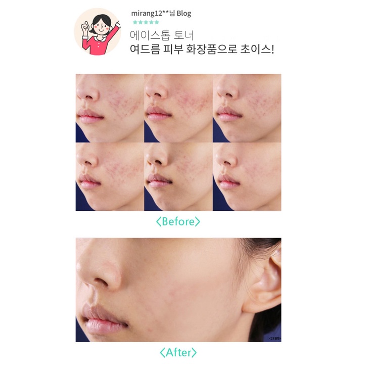 (DATE 10/23) [Tinh chất da mụn chứa BHA + AHA] Huyết thanh thay đổi làn da mụn trong 5 ngày A.Stop Clear Serum (Hàn)