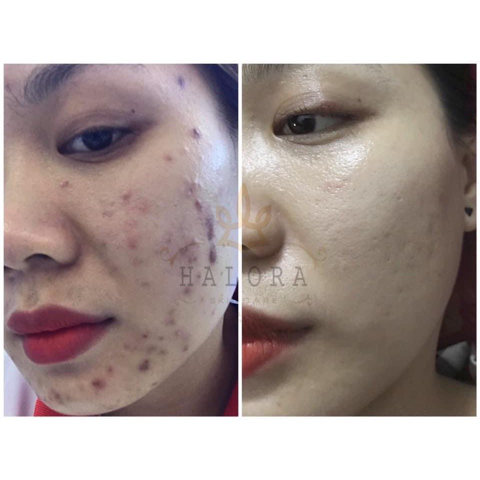 Serum Mụn Haloro Giúp Ngăn Ngửa Các loại Mụn, Dị Ứng Da, Thâm Sạm Nám [ CHÍNH HÃNG] Liệu Trình Chăm Sóc Da Mụn Tại Spa | BigBuy360 - bigbuy360.vn