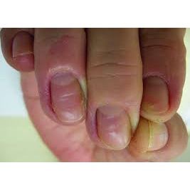 Thảo dược đánh bay V.i.ê.m KẼ_MÉ MÓNG NGÓN TAY, CHÂN do lấy da thừa móng tay, chân_Sẵn Có