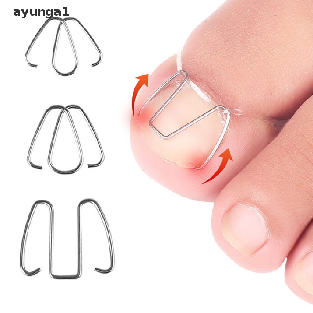 [ayunga1] Nail Art Ingrown Toe Nail Correction Tool Toenail Nail Orthosis Paronychia Clip [new]