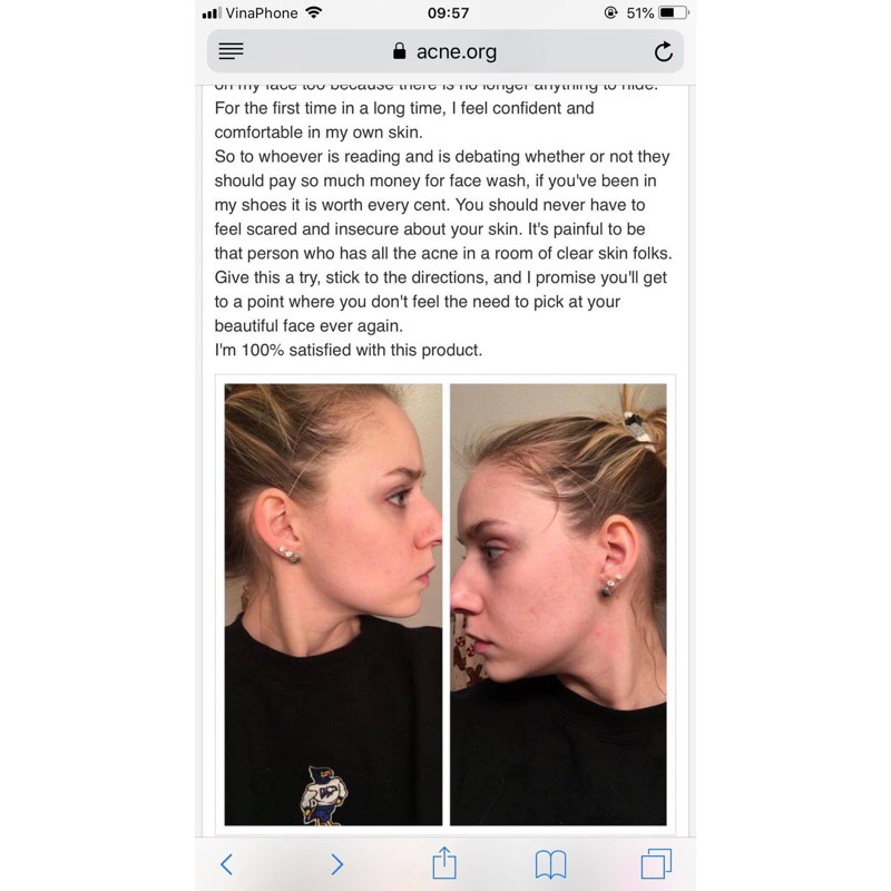 Kem chấm mụn treatment acne.org benzoyl peroxide - Chính hãng