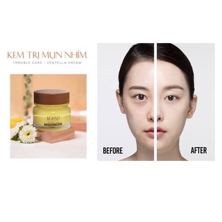 Kem chấm giảm mụn KOSXU