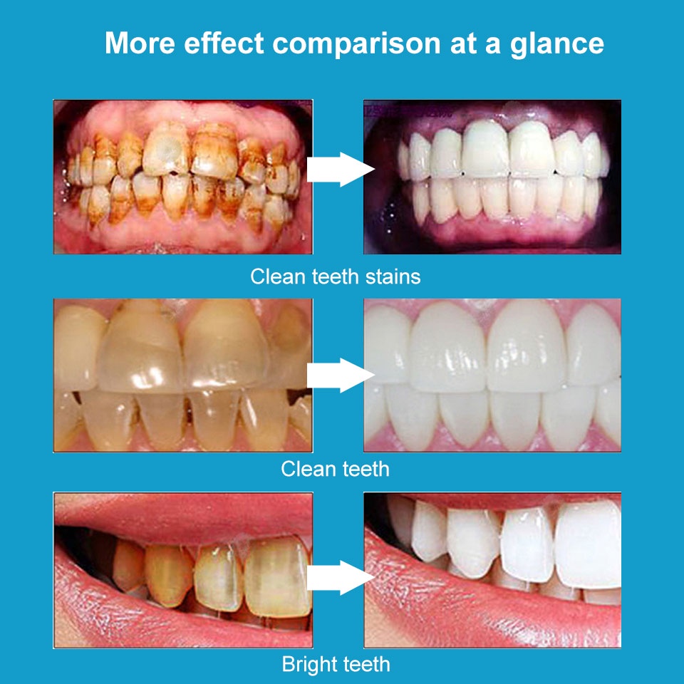 Bút Làm Trắng Răng 3D 5ml Giúp Loại Bỏ Mảng Bám Và Làm Trắng Răng