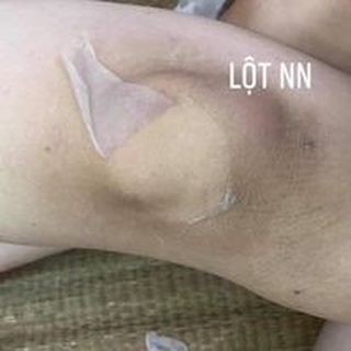 Lột thâm nách