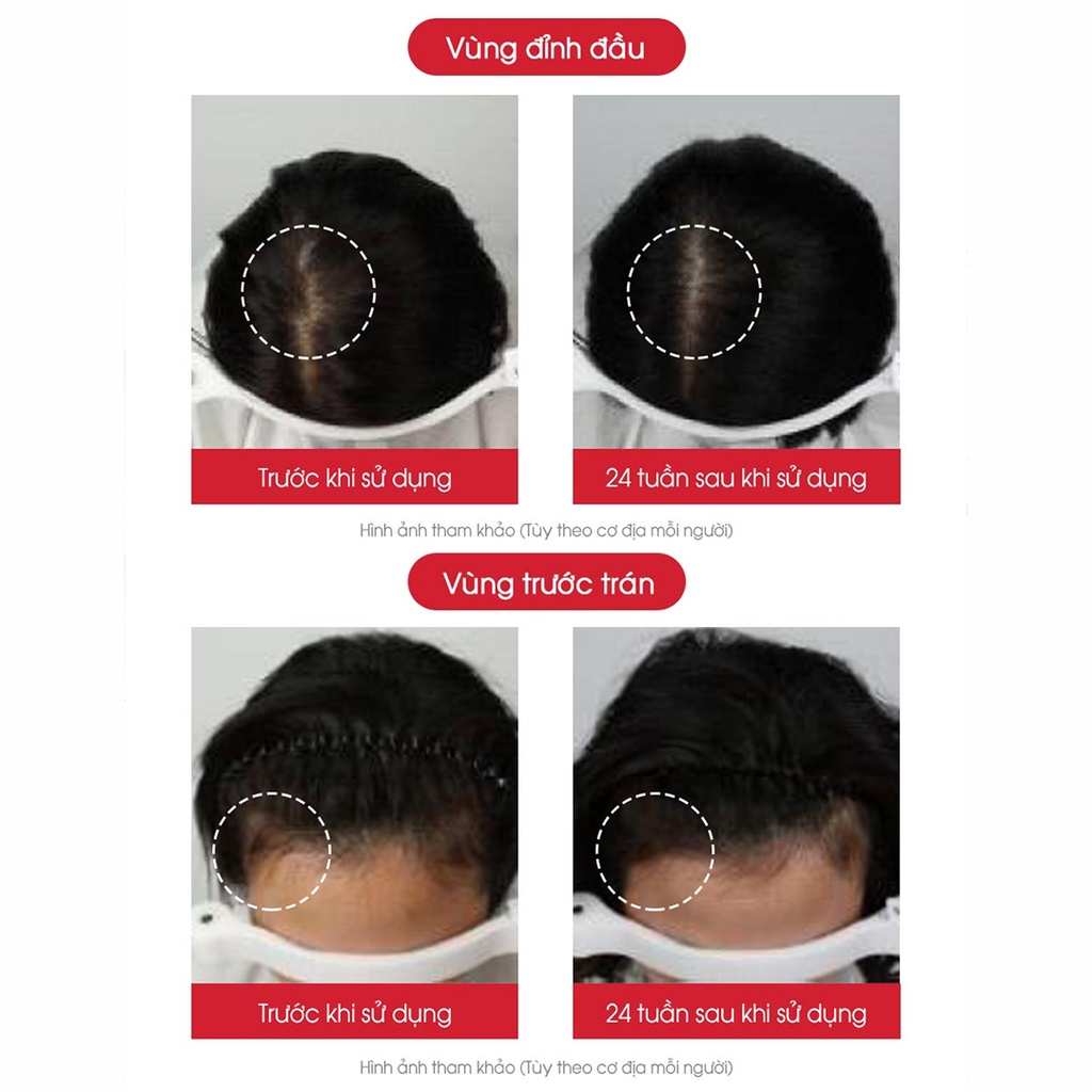 SET 3 CHAI Tinh dầu kích mọc tóc TERAPIC Premium Total Hair Tonic Mini