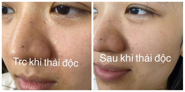 Mặt nạ thải độc trắng da(Detox Whitening Mask)