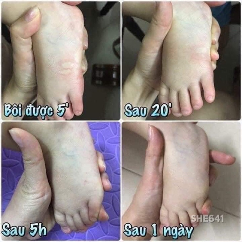 Cao bôi Thươc bôi muỗi đốt côn trùng cắn Thái Lan (Hàng xt trực tiếp) - CÓ SẴN