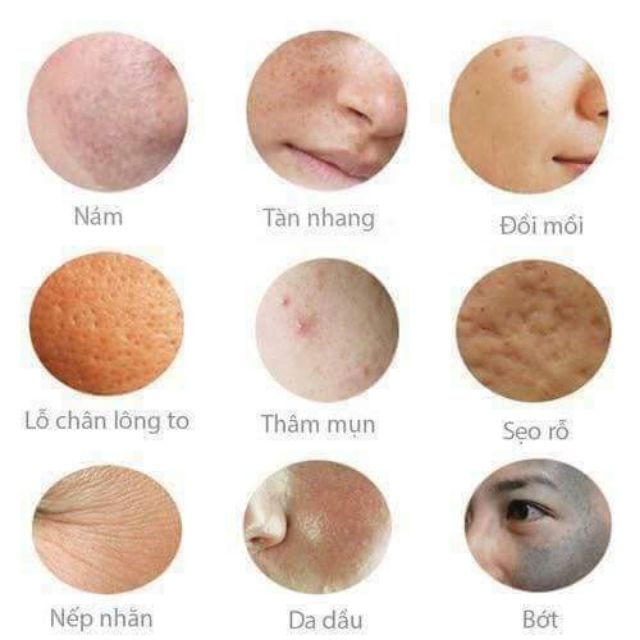 BỘ KEM NÁM TÀN NHANG CLOBETAMIL G CAO CẤP