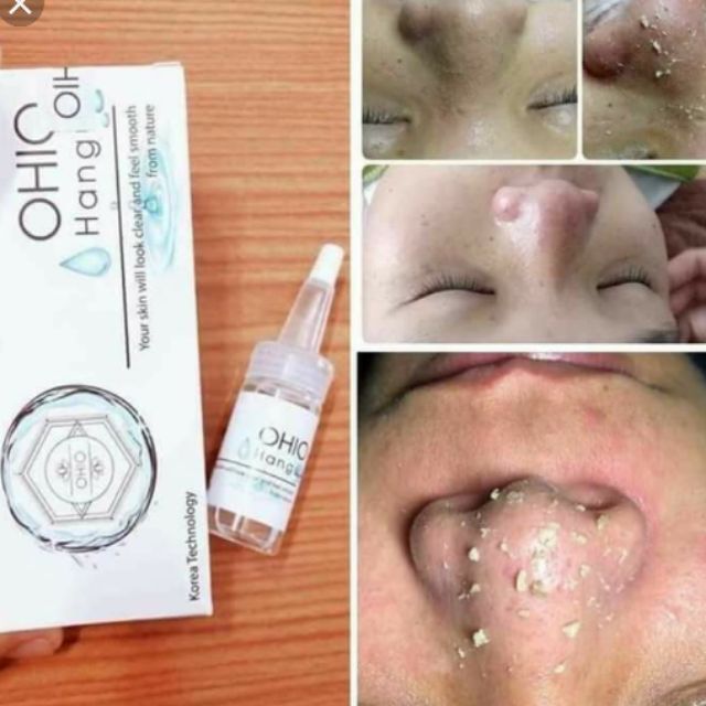 Combo 30 ủ mụn+ serum se khít OHIO