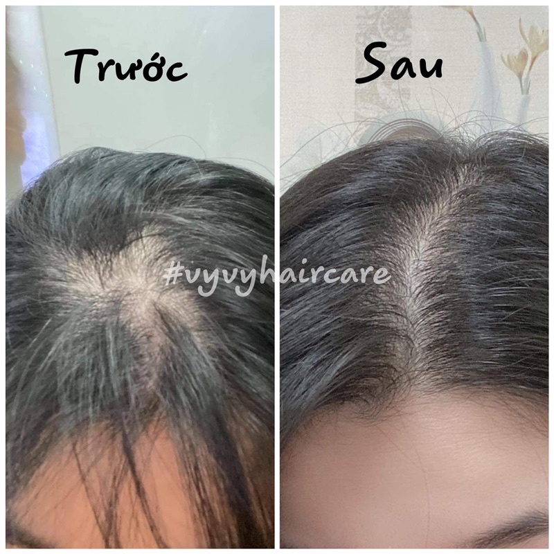 Combo dưỡng ngăn rụng, kích mọc, dưỡng bóng VyvyHaircare