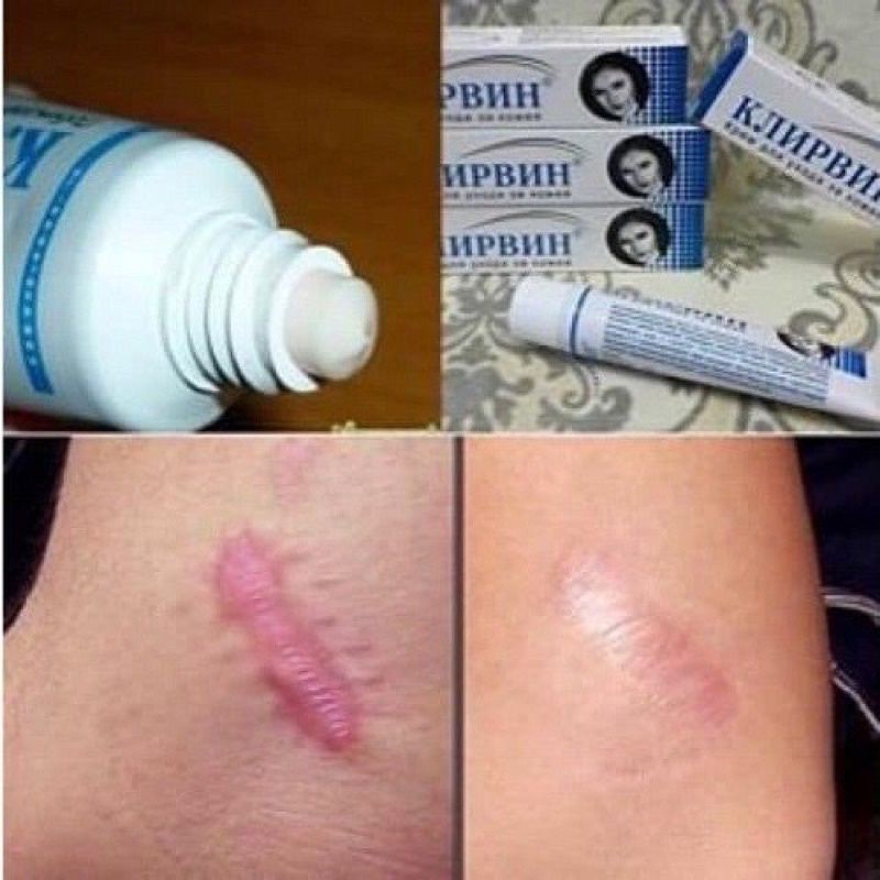 Kem làm mờ sẹo Nga 25g