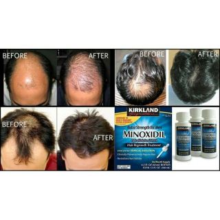 MINOXIDIL 5% KIRKLAND CỦA MỸ 🎩 CHỐNG RỤNG TÓC VÀ HÓI ĐẦU CHO NAM GIỚI