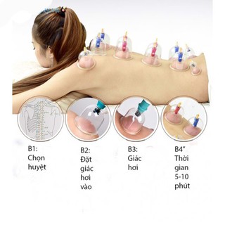 Bộ giác hơi 12 món không dùng lửa