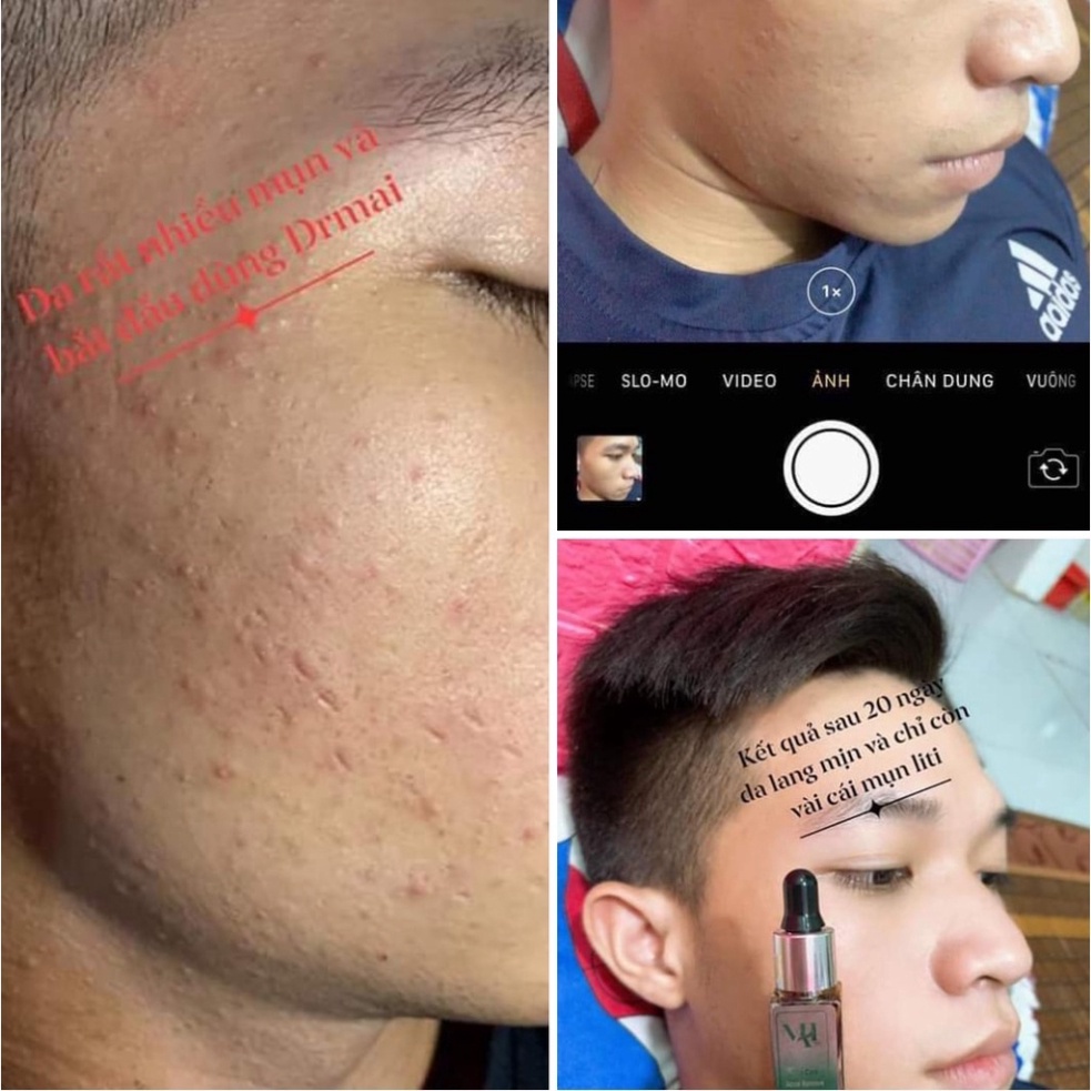 Combo tri mun Dr mai [CHÍNH HÃNG] ✅