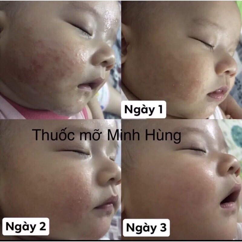 5 hộp kem mơ minh hùng (100% hàng công ty-2024)
