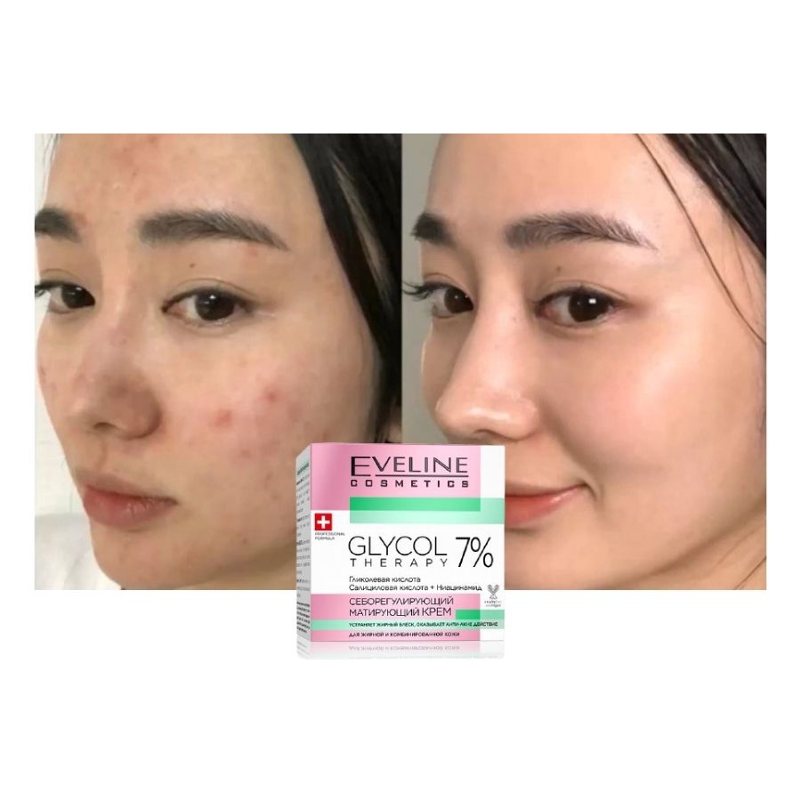 Kem dưỡng Eveline Glycol Therapy 7% ngừa mụn, mờ thâm 50ml