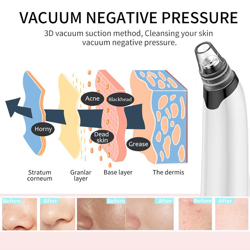 [Mã FMCGM50 - 8% đơn 250K] ANLAN Blackhead Vacuum Remover Facial Cleansing Beauty Tool