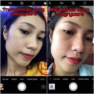 BAY MỤN RubyCare