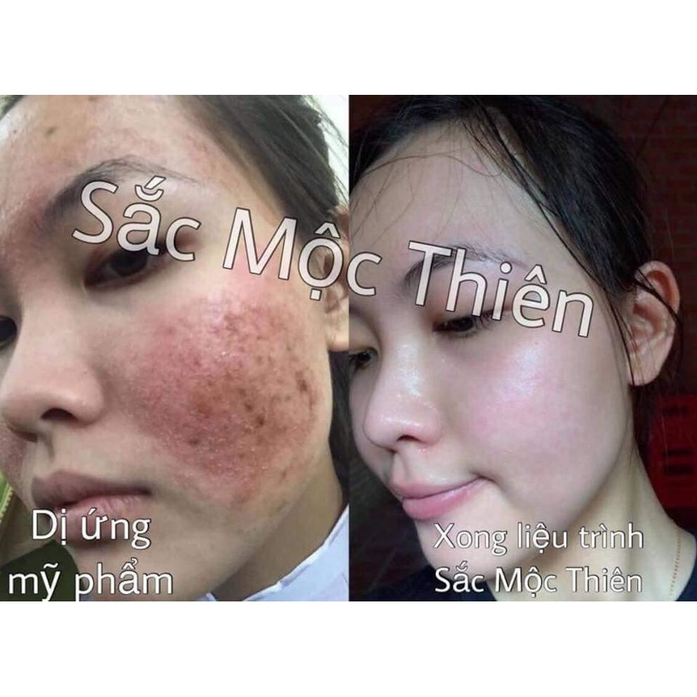 Cải Thiện Mụn, Thâm Nám, Tàn Nhang, Rỗ Tái Tạo Da Sắc Mộc Thiên hàng chuẩn bán Sỉ | BigBuy360 - bigbuy360.vn