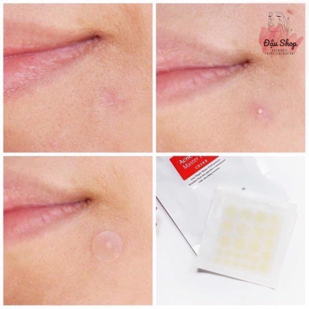 Miếng dán mụn Cosrx Acne Pimple Master Patch