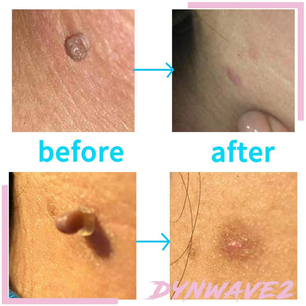 Bộ Dụng Cụ Loại Bỏ Đốm Đen Trên Da Dynwave2