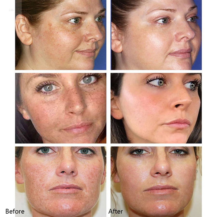 Kem Vitamin C 20% Làm Trắng Xóa Đốm Đen Và Làm Sáng Da Mặt 30ml