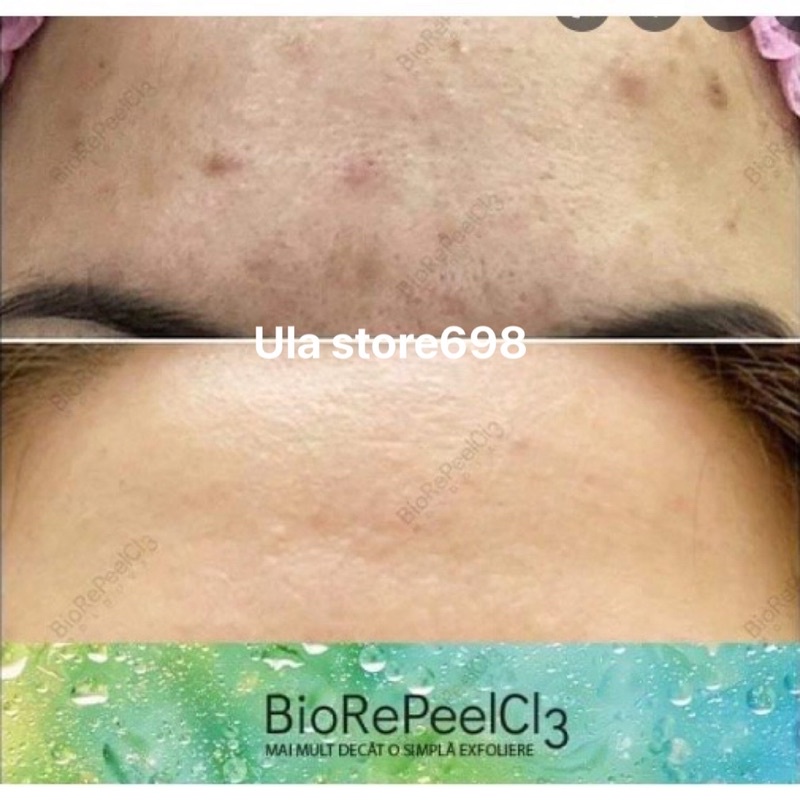 Tinh Chất Peel Da Italy Giảm Mụn Căng Bóng Trẻ Hóa Da Biore Peel.Cl3