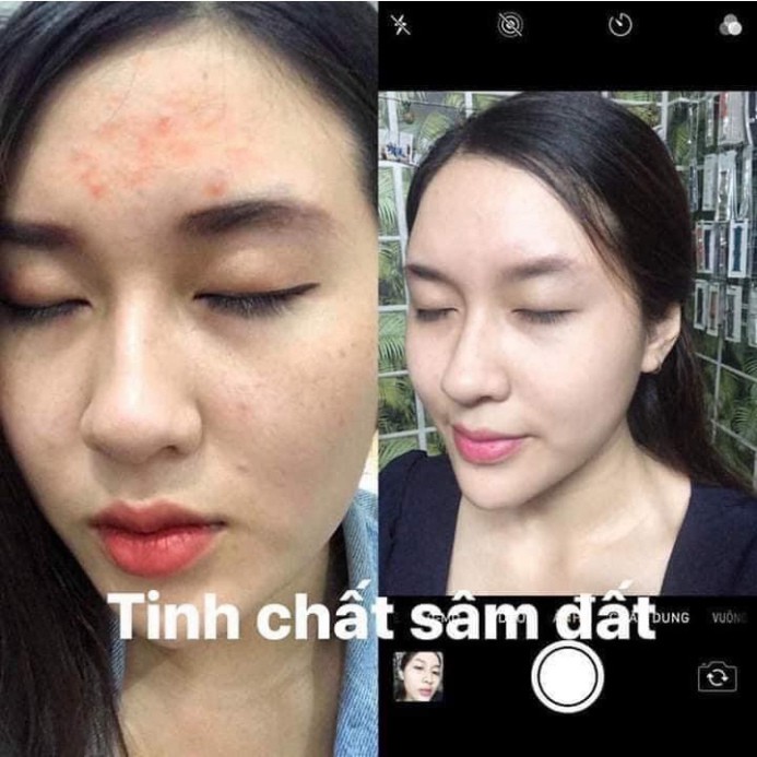 Tinh Chất Sâm Đất, Đánh Bay Mụn Nhanh Chong, Tái Tạo Da, Giảm Thâm, Se Khích Lỗ Chân Lông, 50ml Chính Hãng | BigBuy360 - bigbuy360.vn