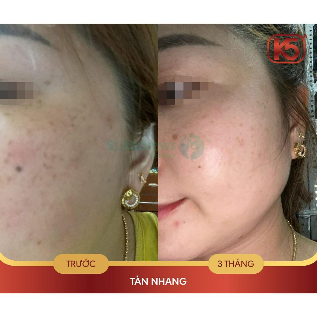 Kem chống tăng sắc tố sau laser K5 Cryolaser 20ml - hiệu quả đã được chứng minh